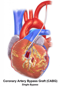 Coding guidelines for Coronary artery bypass procedures